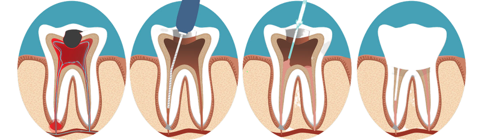 https://hillsdentcenter.com/wp-content/uploads/2025/01/rootcanal-transformed1.png